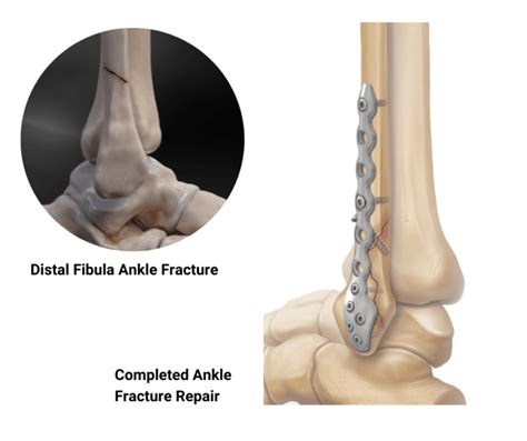 Ankle Fractures | Dr. Edward S. Chang, MD