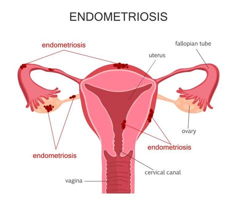 Gevolgen van endometriose · Endometriose stichting