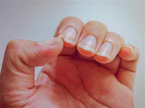 Iron deficiency: Some serious signs may appear on skin, nails and taste ...