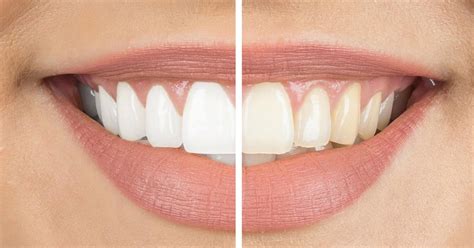 The Best Ways to Whiten Your Teeth – My Kind Red Life