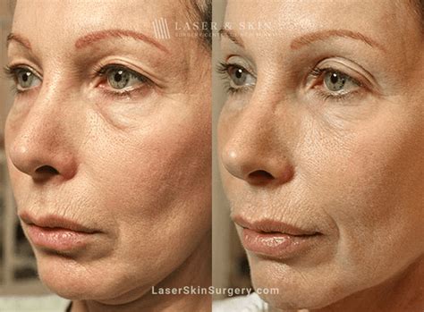 Laser Skin Tightening: What Is It and How Long Does It Last? - Laser NY