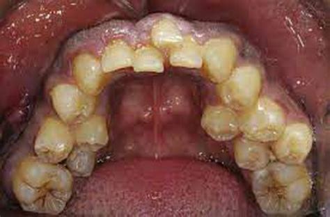 What causes hyperdontia? - MEDizzy