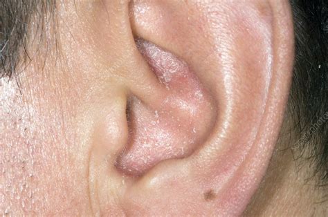 Psoriasis in the ear - Stock Image - C008/5733 - Science Photo Library