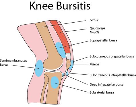 Infrapatellar bursitis causes, symptoms, diagnosis & treatment