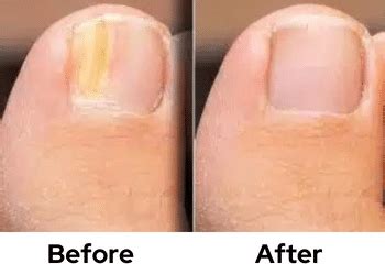 Nail Fungus: Causes, Symptoms, Treatments, And Prevention, 60% OFF