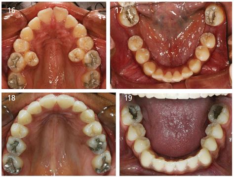 Guest Editorial: Orthodontic Extraction Therapy: A Hard Look At the ...