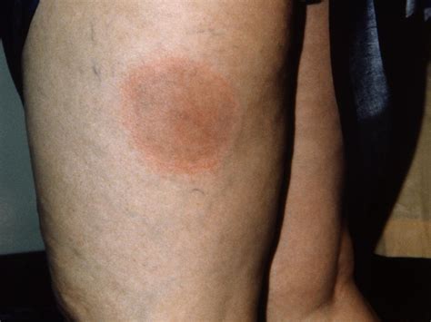 Lyme disease rash: Symptoms, stages, and identification