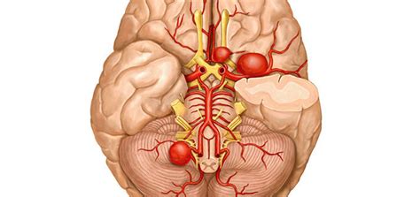 Rupture Rates for Small Brain Aneurysms | Top Neuro Docs