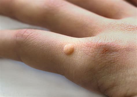 Common Warts (Verruca Vulgaris) | Mclean VA & Woodbridge, VA | Skin ...