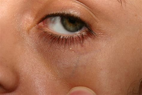 Milia - Causes, Milia On Face, Eyelid & How To Get Rid of It