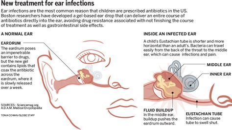 An antibiotic gel could treat kids' ear infections with one dose