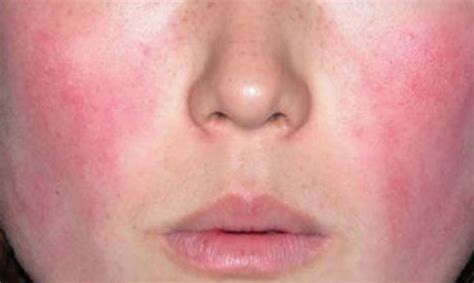 Rosacea - Symptoms and treatment - Your Great Skin