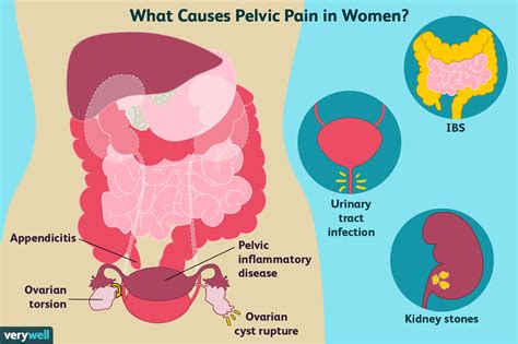 Pelvic Pain: Causes in Women and Men and Treatment