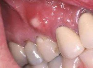 White Bump on Gums: Causes and Treatment | UtoDent.com