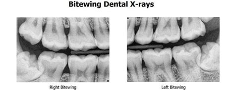 Decoding Bitewing X-rays: A Complete Guide to Understanding and Reading the Images