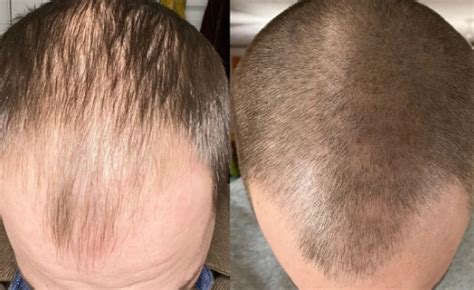 Minoxidil Results After 1 Year - Wimpole Clinic