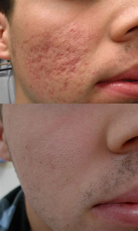 CO2 Laser Resurfacing For Acne Scars - Cutis Dermatology