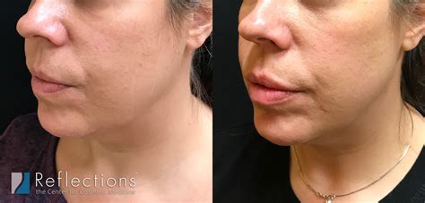 Lip Filler, Chin Filler, & Filler in Marionette Lines to Remove Jowls ...