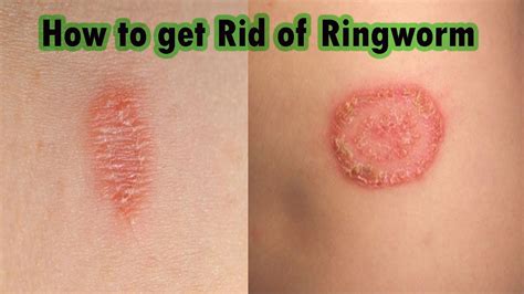Ringworm Symptoms Causes Treatment | My XXX Hot Girl
