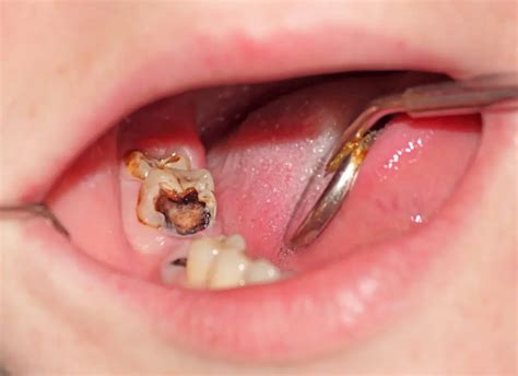 Tooth Decay - Dentist Brisbane