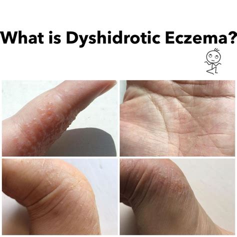 What is Dyshidrotic Eczema? Blisters on fingers, hands, and feet. #WartsRemedies #eczemalotions ...