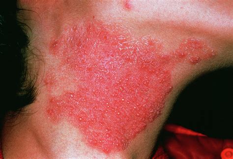 Fungal Skin Infections