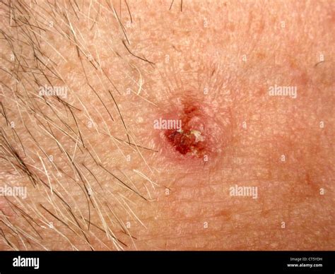 Malignant Tumor High Resolution Stock Photography and Images - Alamy