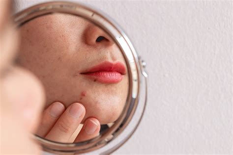 How to Treat Those Pesky Pimples Around Your Mouth | Software