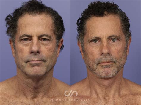 Los Angeles Facelift for Men