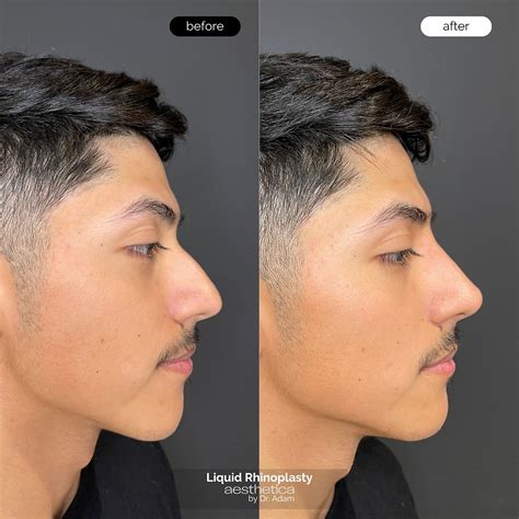 How Long Does Liquid Rhinoplasty Last, and What is the Recovery Time Like?