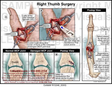 Right Thumb Surgery MediVisuals Medical Illustration