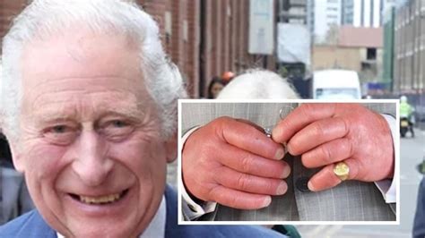 Prince Charles ‘sausage fingers' spark concern; doctor explains its ...