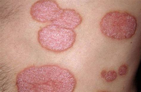 What does plaque psoriasis look like | Symptoms and pictures