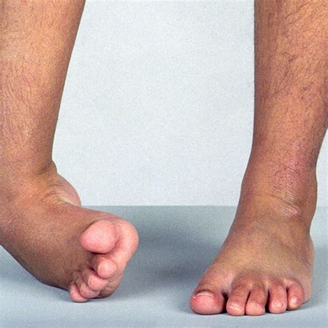 Ten-year-old boy with severe equinovarus deformity right foot. Pain was... | Download Scientific ...