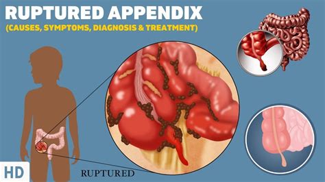 Ruptured Appendix: What It Feels Like and How to Recognize the Symptoms ...