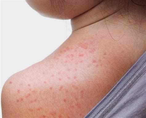 Suffering From Sweat Rashes? These Home Remedies Will Cure & Soothe You! | HerZindagi