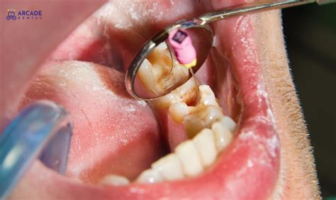 Preventing Root Canal Infections: Tips for Good Oral Health - Arcade Dental