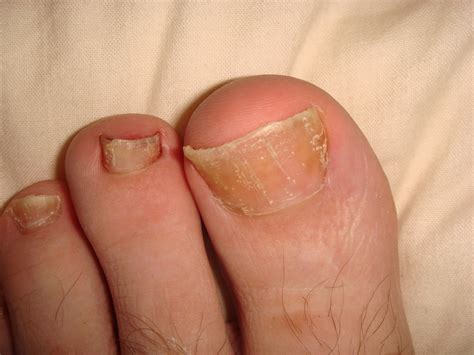 Psoriasis in the fingernails and toenails