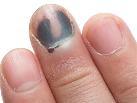 Do you know these nail disorders and abnormalities? – J. Soltman Photography