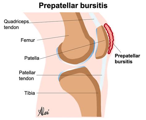 Prepatellar bursitis aspiration & cortisone injection | Musculoskeletal Ultrasound & Injections