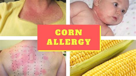 Corn allergy Symptoms – Causes Symptoms and Pictures of Corn allergy ...