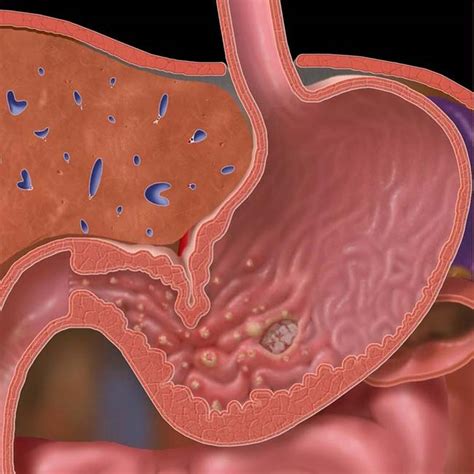 Erythema In The Antrum Biopsy