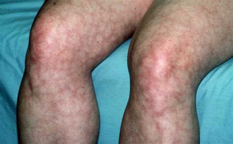 Livedo Reticularis - Skin Disorders