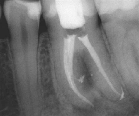 Diagnosis of Endodontic-Periodontal Lesions - Decisions in Dentistry