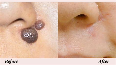 7 Surefire Ways Mole Removal Will Drive Your corporation Into The ...