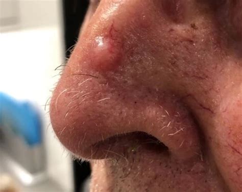 Basal cell carcinoma - MySkinDoctor