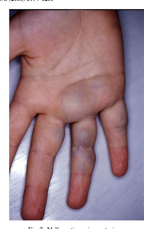 Figure 7 from [Vascular anomalies of the children's hand]. | Semantic Scholar