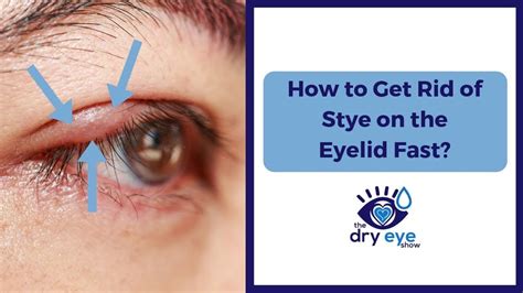 👁️👁️ How to Get Rid of a Stye On the Eyelid Fast 👁️👁️ | Eye stye remedies, Dry eye treatment ...
