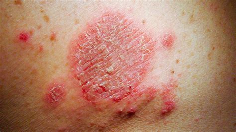 Skin rashes that itch all over body - Hoplog