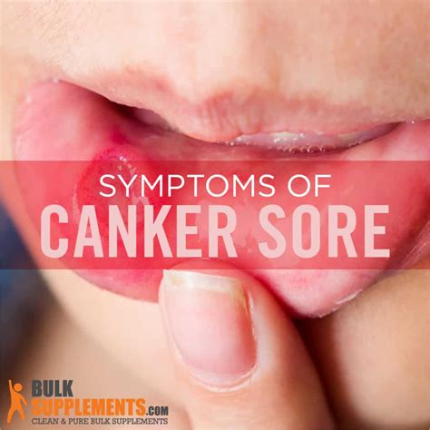 Canker Sore Symptoms And Treatments - Infoupdate.org